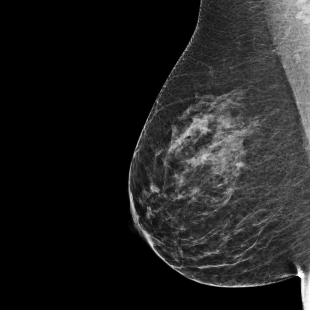 category b mammogram scan