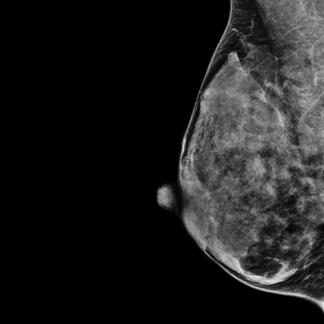 category d most dense mammogram scan