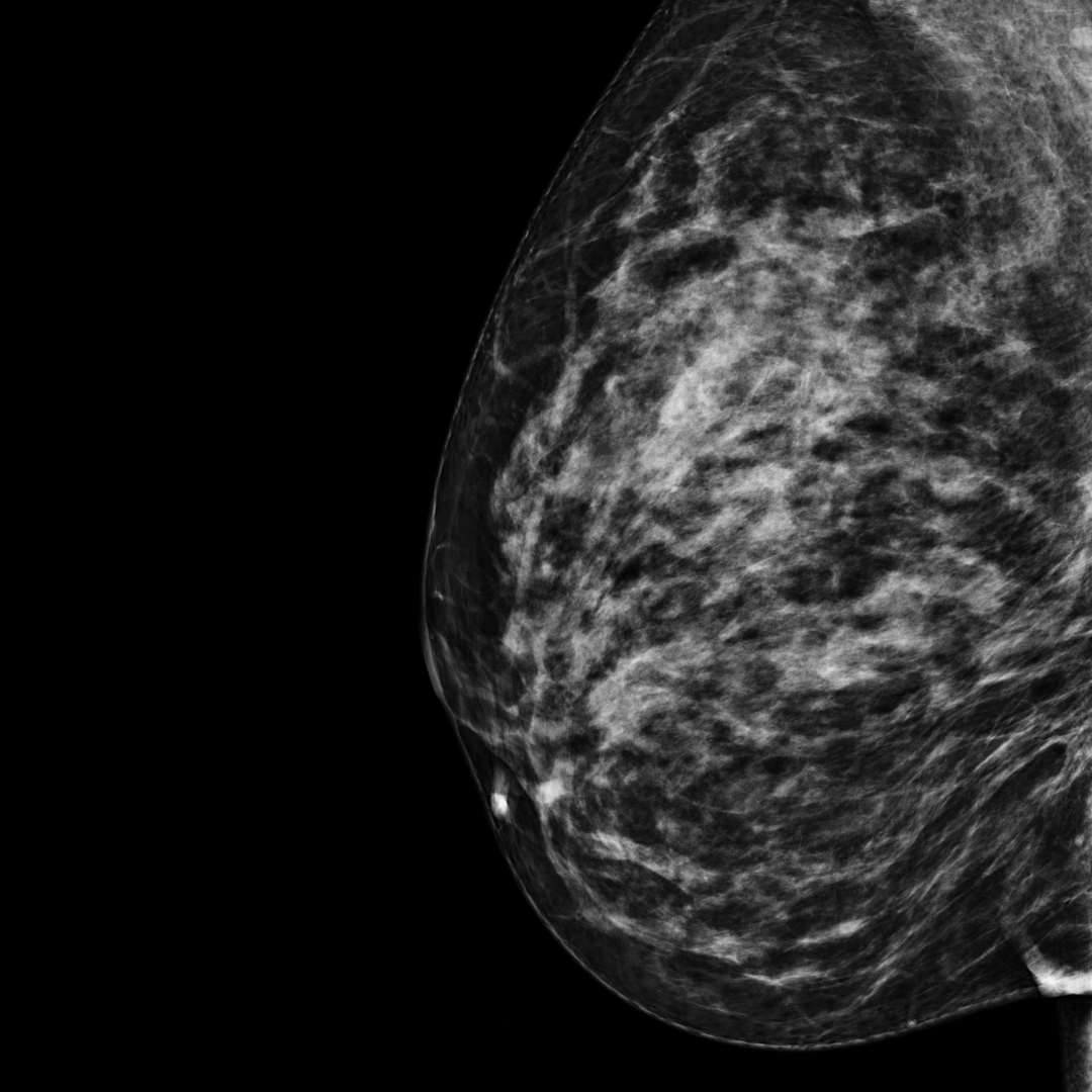 category c mammogram scan