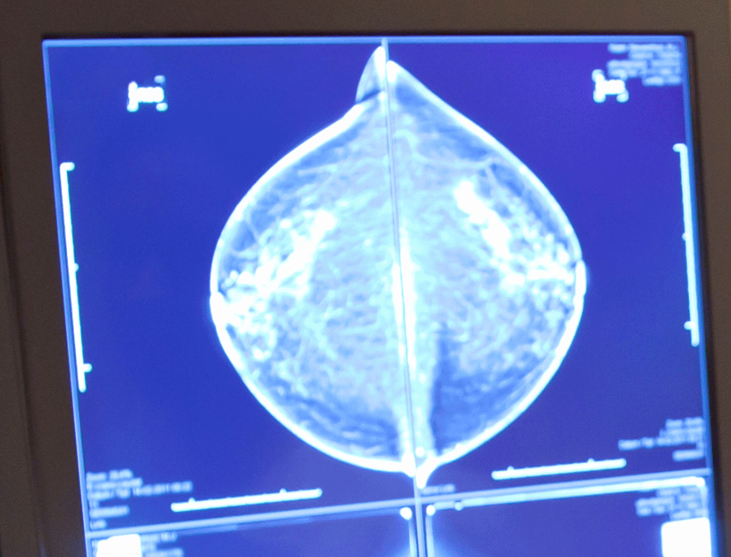 Breast imaging mammogram on screen